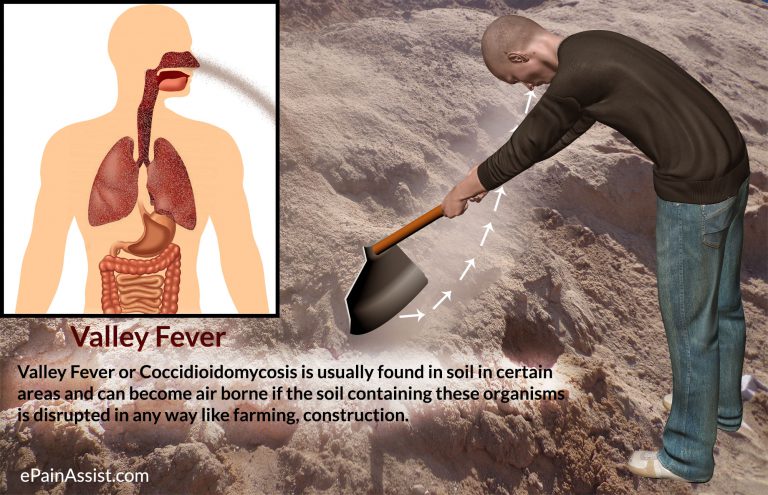 Valley Fever or Coccidioidomycosis: Causes, Risk Factors, Symptoms, Diagnosis, Treatment, Prevention