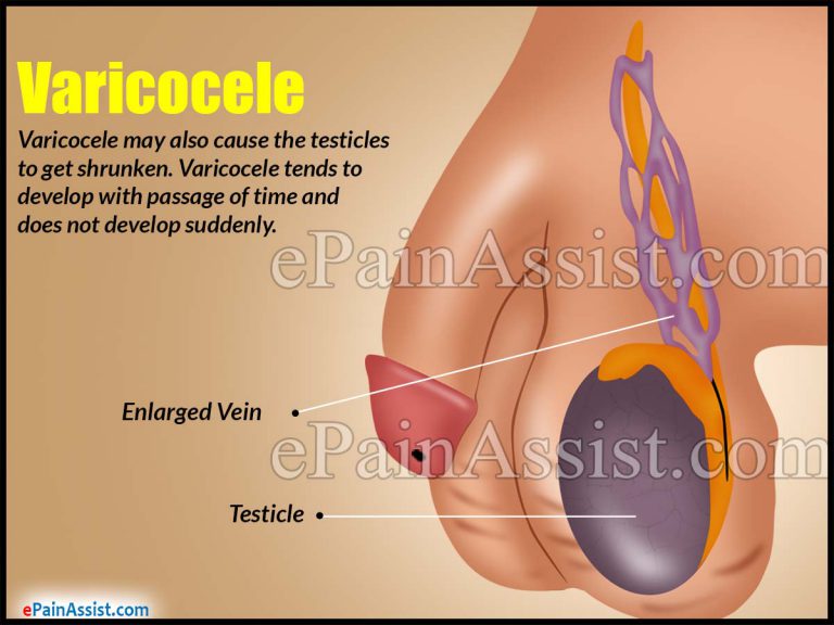 Varicocele: Causes, Risk Factors, Symptoms, Diagnosis, Treatment, Home Remedies