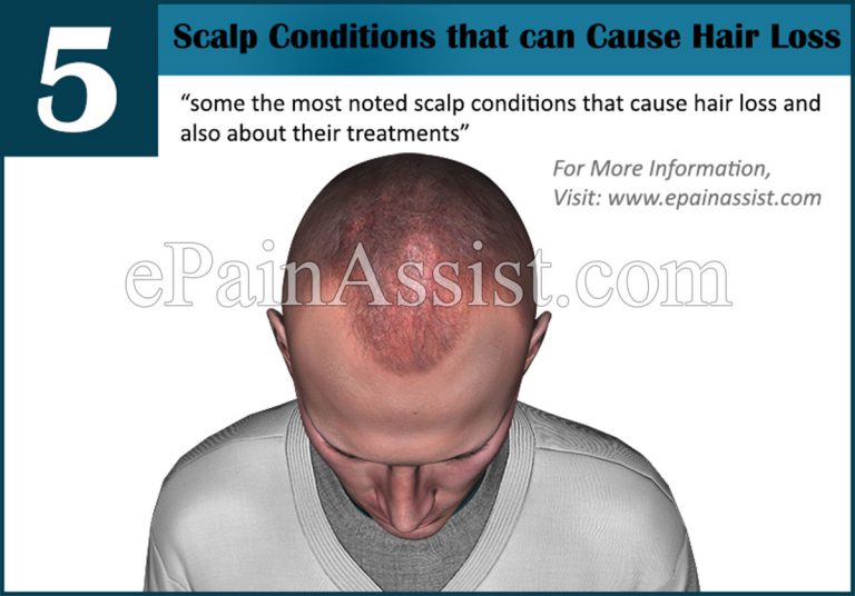 Scalp Conditions that Cause Hair Loss & its Treatment