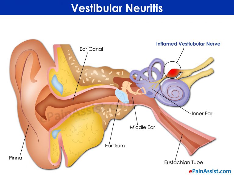 Vestibular Neuritis : Causes, Symptoms, Treatment, Balance Rehabilitation Program, How Long Does It Last?