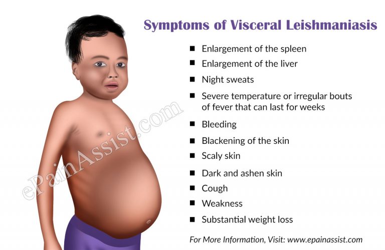 Visceral Leishmaniasis or Kala Azar: Symptoms, Treatment, Causes