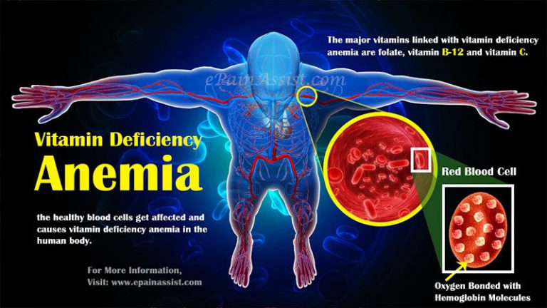 Vitamin Deficiency Anemia: Symptoms, Causes, Treatment