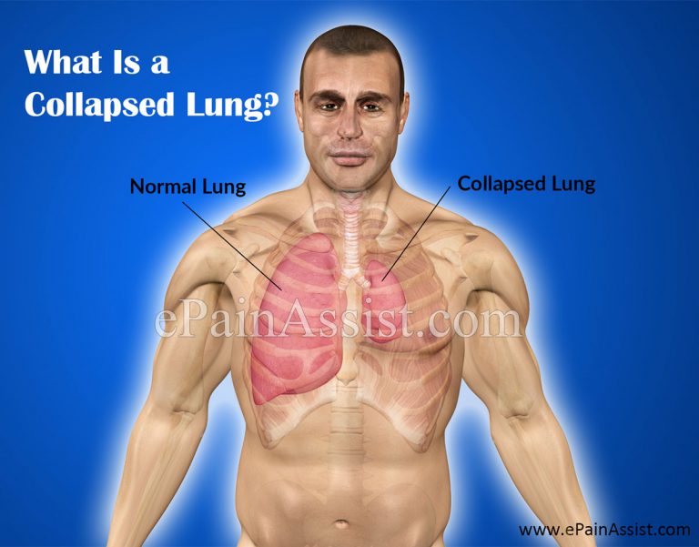 What Is a Collapsed Lung or Pneumothorax: Causes, Symptoms, Signs, Types