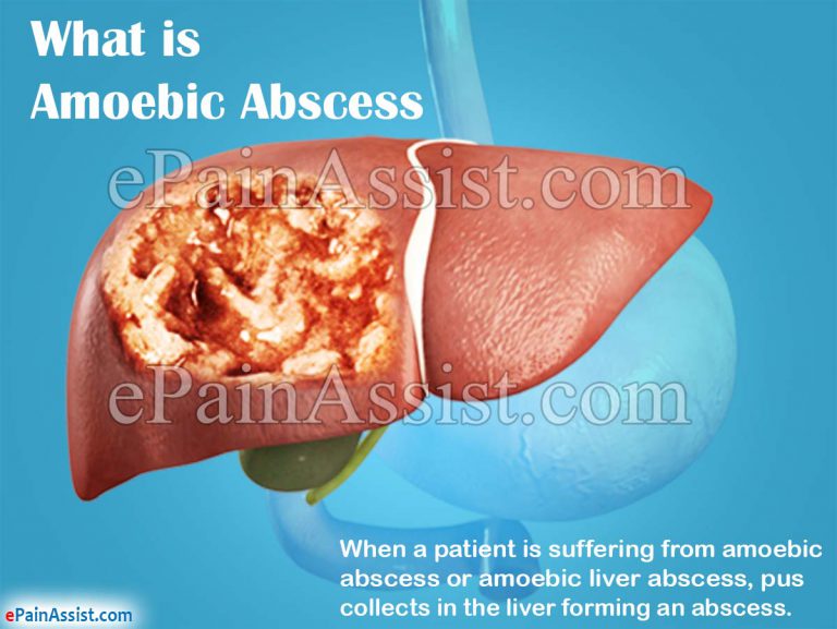 What is Amoebic Abscess or Amoebic Liver Abscess: Causes, Symptoms, Diagnosis, Prevalence