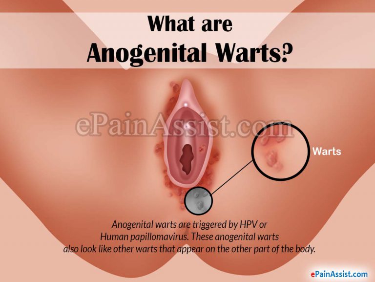 What are Anogenital Warts: Causes, Symptoms, Risk Factors, Complications, Diagnosis