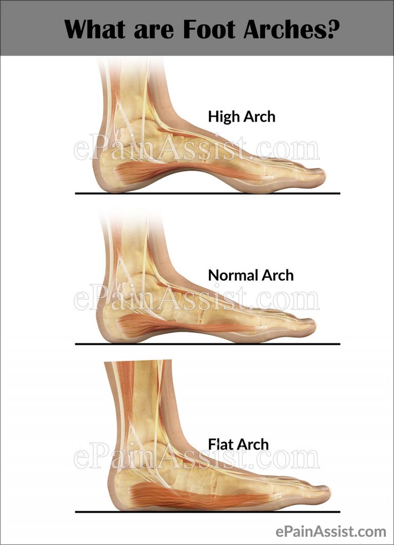 Arch Strain: What Causes Pain in the Arch of the Foot?
