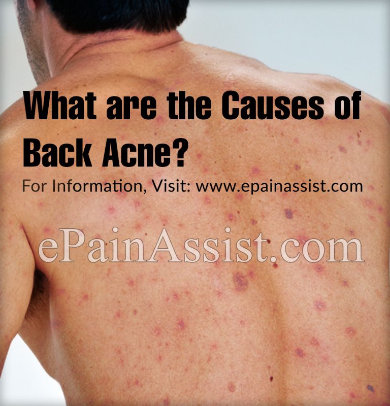 What are the Causes of Back Acne & What is Its Solution?