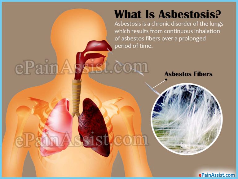 Asbestosis: Causes, Symptoms, Diagnosis, Treatment, Home Remedies, Prevention