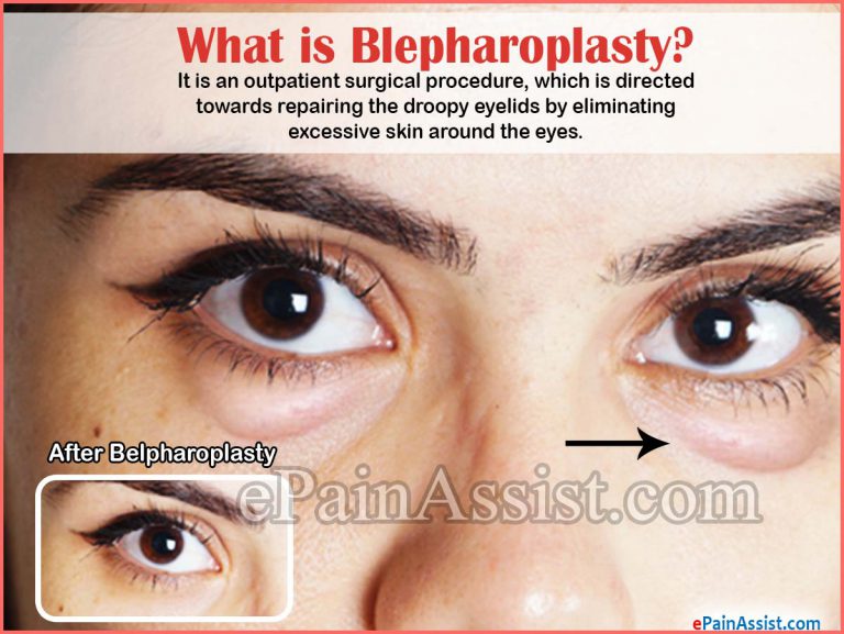 Why & How is Blepharoplasty Done? Know the Recovery Period & Complications of Blepharoplasty