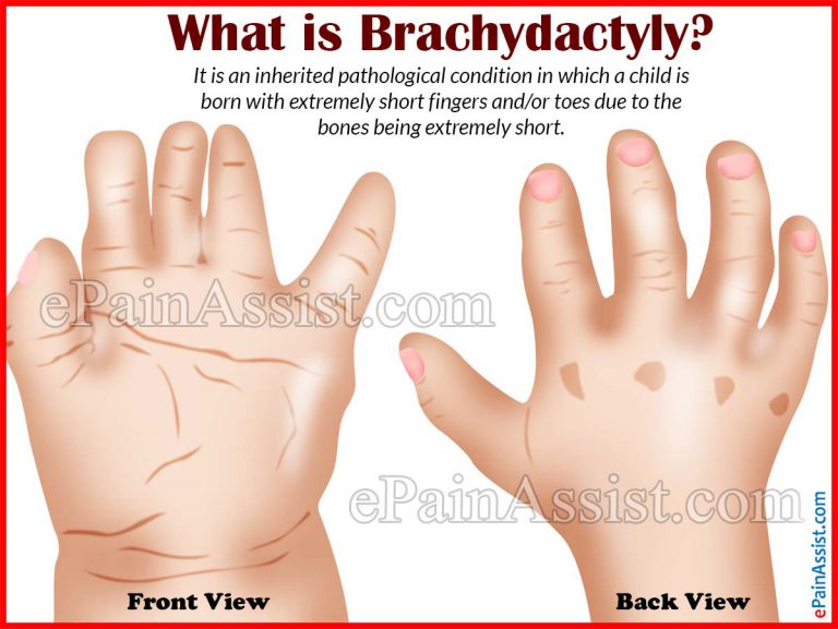 What Causes Brachydactyly & What is Its Treatment?