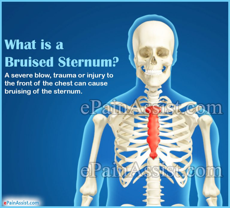 Bruised Sternum: Causes, Signs, Symptoms, Treatment, Home Remedies
