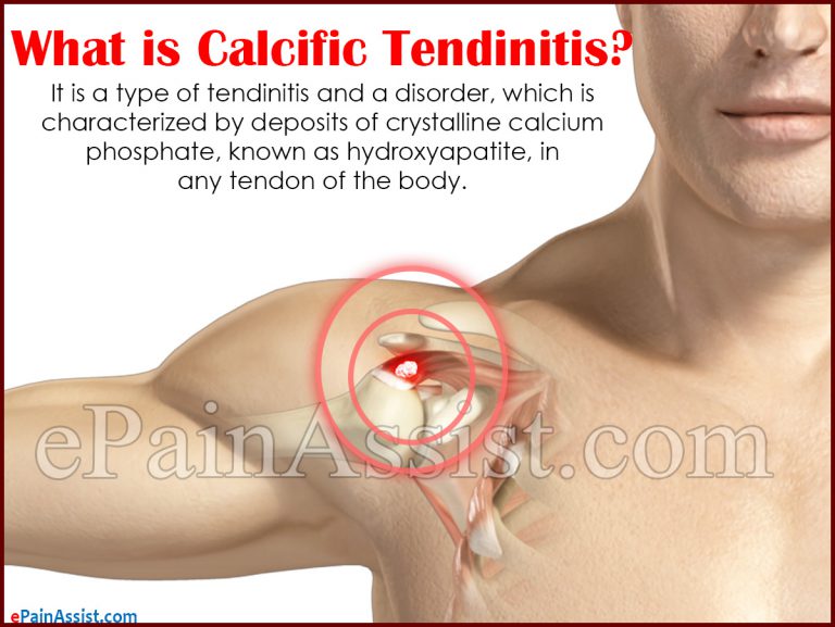 Calcific Tendinitis: Causes, Signs, Symptoms, Treatment