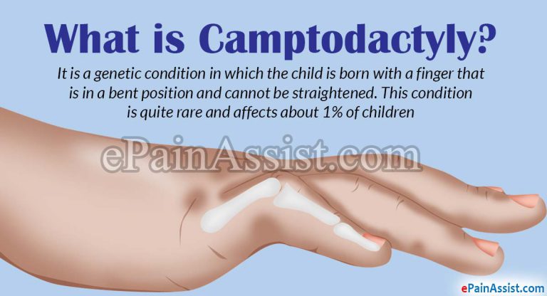 What is Camptodactyly, Know its Causes & Treatment