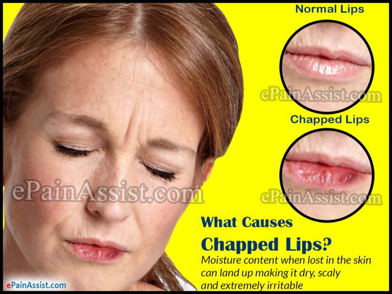 How to Fix Chapped Lips | Best Remedies for Chapped Lips