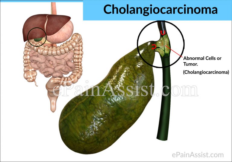 What Causes Cholangiocarcinoma & What are its Symptoms & Pathophysiology?