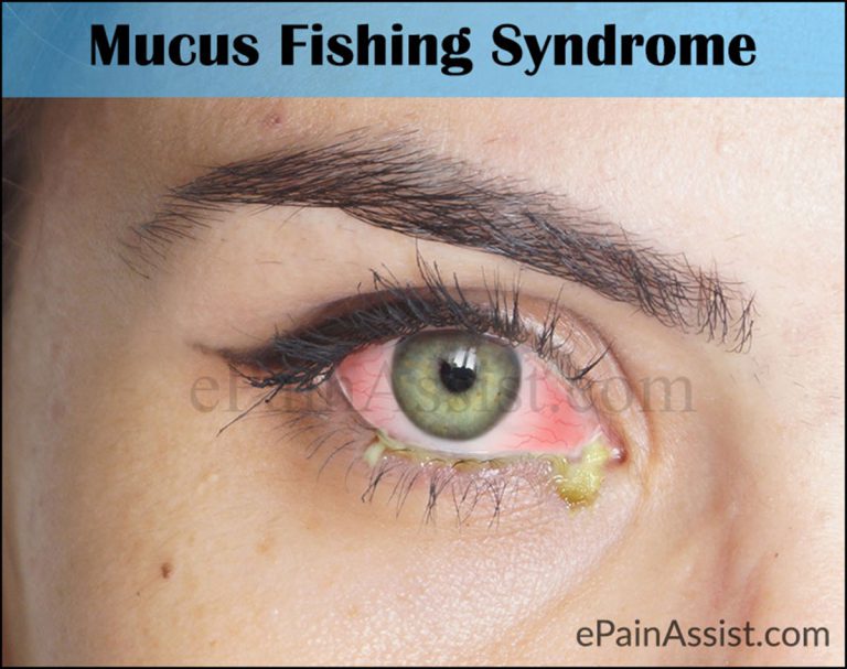 What Causes Fishing Mucus Syndrome and What is its Treatment?
