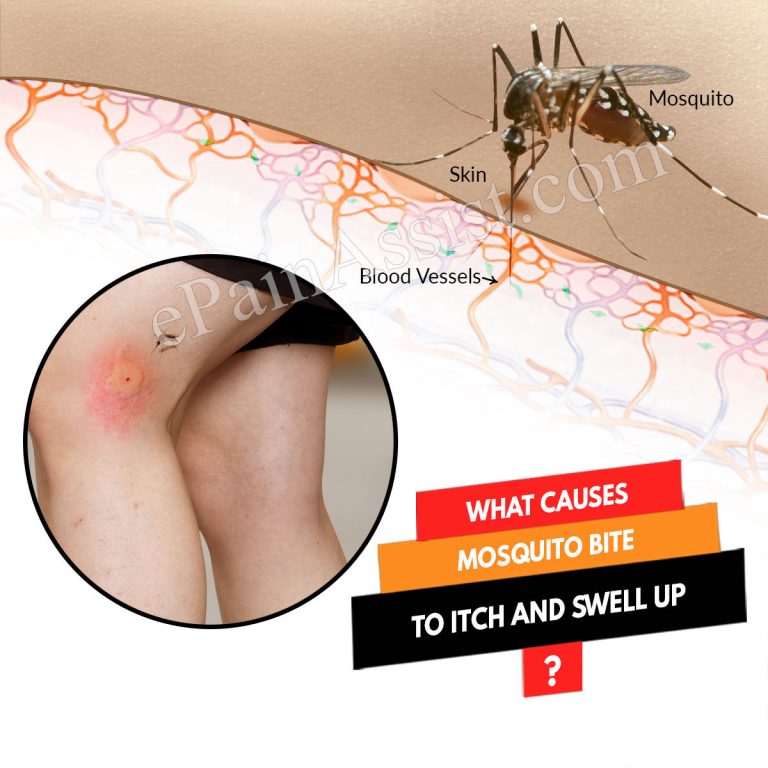 What Causes Mosquito Bite to Itch and Swell up & How to Treat It?