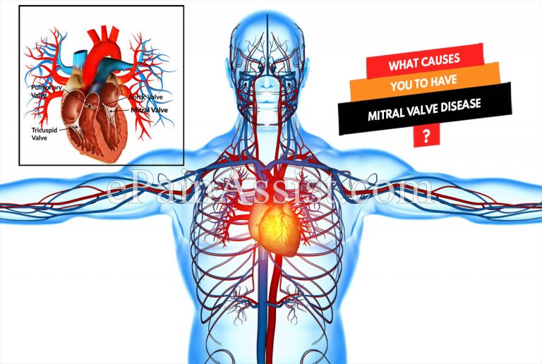 What Causes You To Have Mitral Valve Disease?
