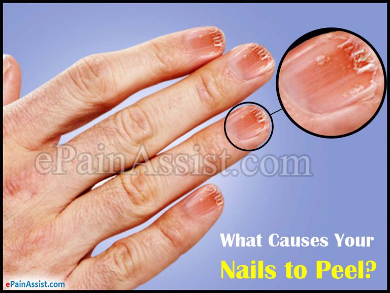 Peeling Finger Nails: What Causes Your Nails to Peel and How to fix it