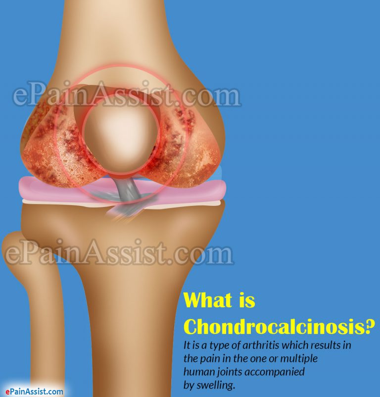 Chondrocalcinosis: Causes, Symptoms, Treatment, Recovery, Exercises, Home Remedies