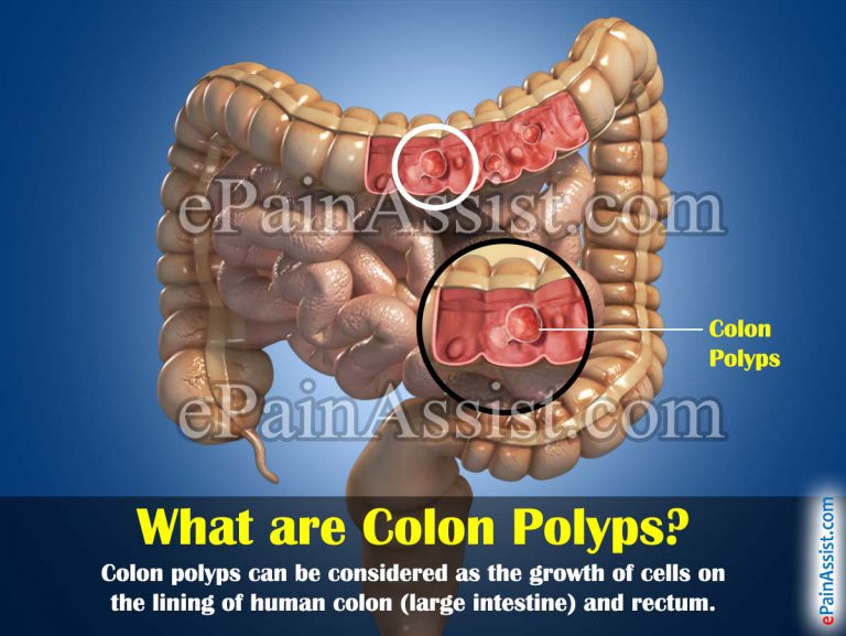 What are Colon Polyps & What are its Causes, Types, Symptoms?