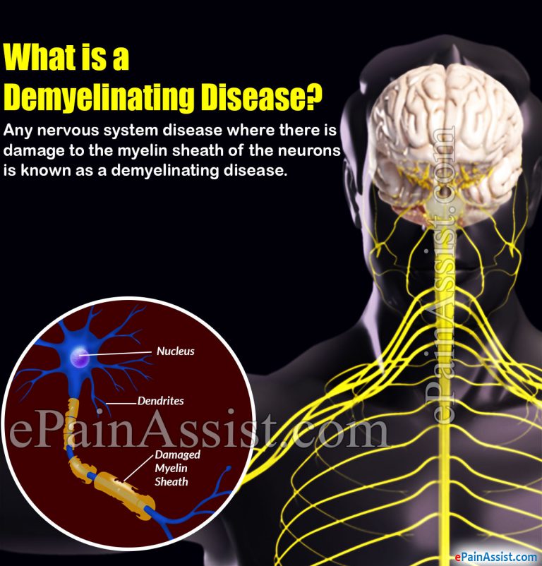 Types of Demyelinating Disease & its Causes, Symptoms, Treatment