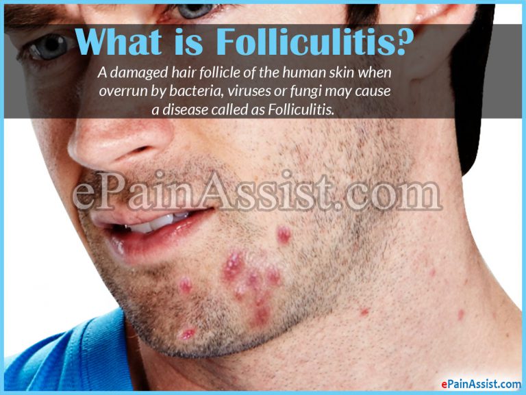Is Folliculitis Contagious and How to Get Rid of It?