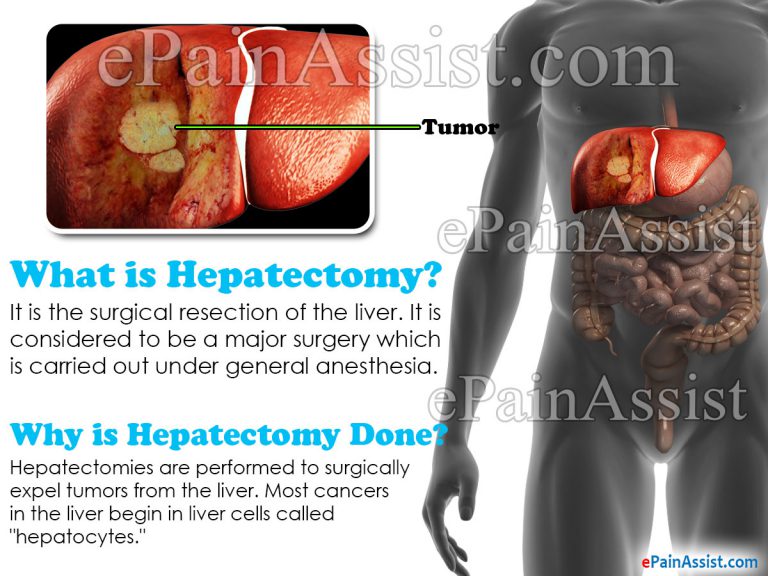 Hepatectomy and Splenectomy: The How’s and Why’s