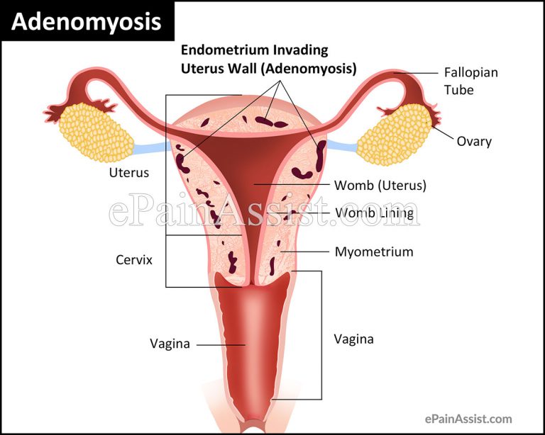 Adenomyosis: Causes, Signs, Symptoms, Treatment, Risk Factors, Diagnosis