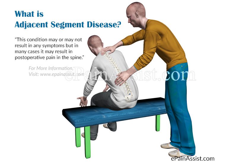 Adjacent Segment Disease: Do All Spinal Fusion Patients Develop Adjacent Segment Disease?