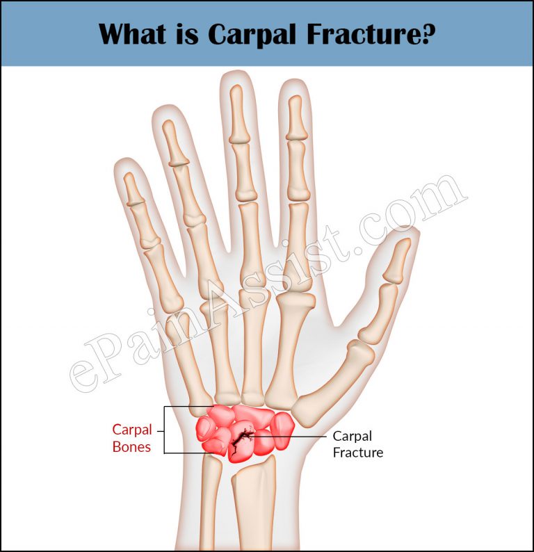 Carpal Fracture: Causes, Symptoms, Treatment- Nonsurgical, Surgical, Exercises