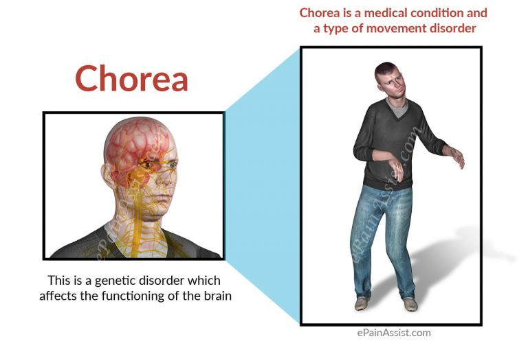 What is Chorea and How Can It Be Treated?