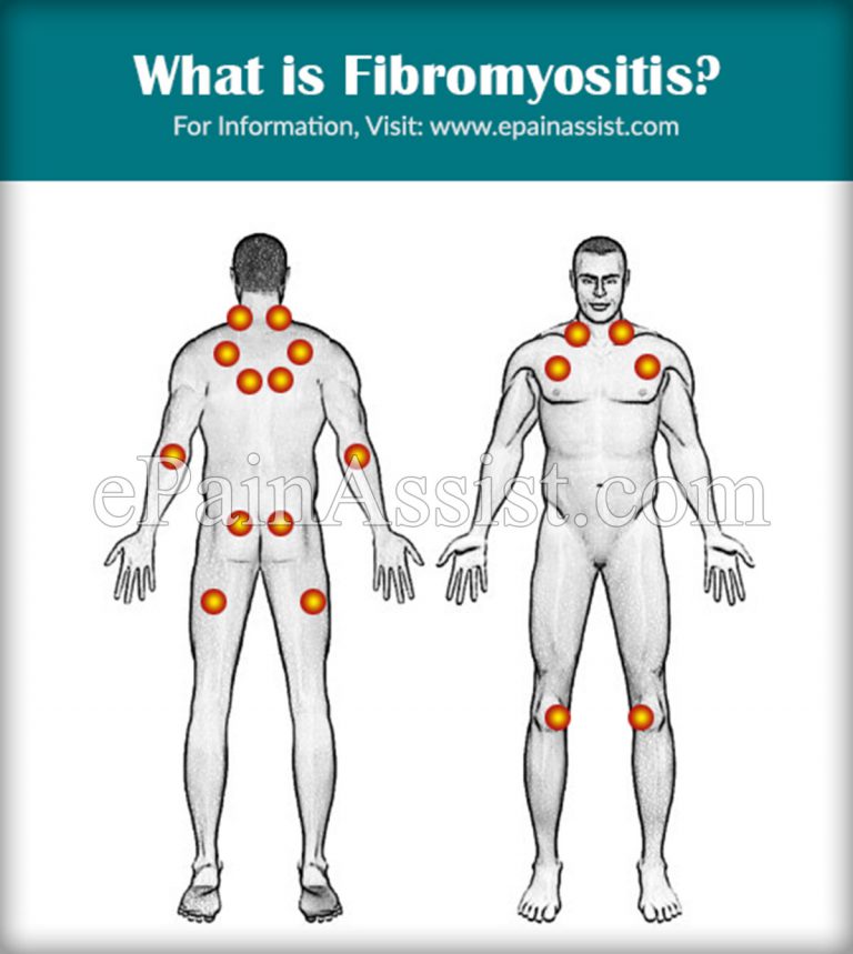 What is Fibromyositis, Know its Causes, Symptoms, Treatments, Prognosis, Prevention