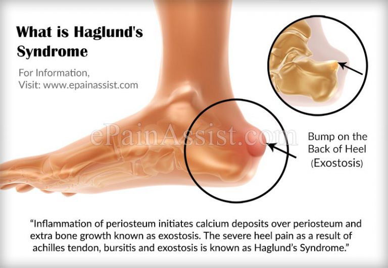 What is Haglund’s Syndrome: Causes, Symptoms, Treatment, Recovery Period, Exercises