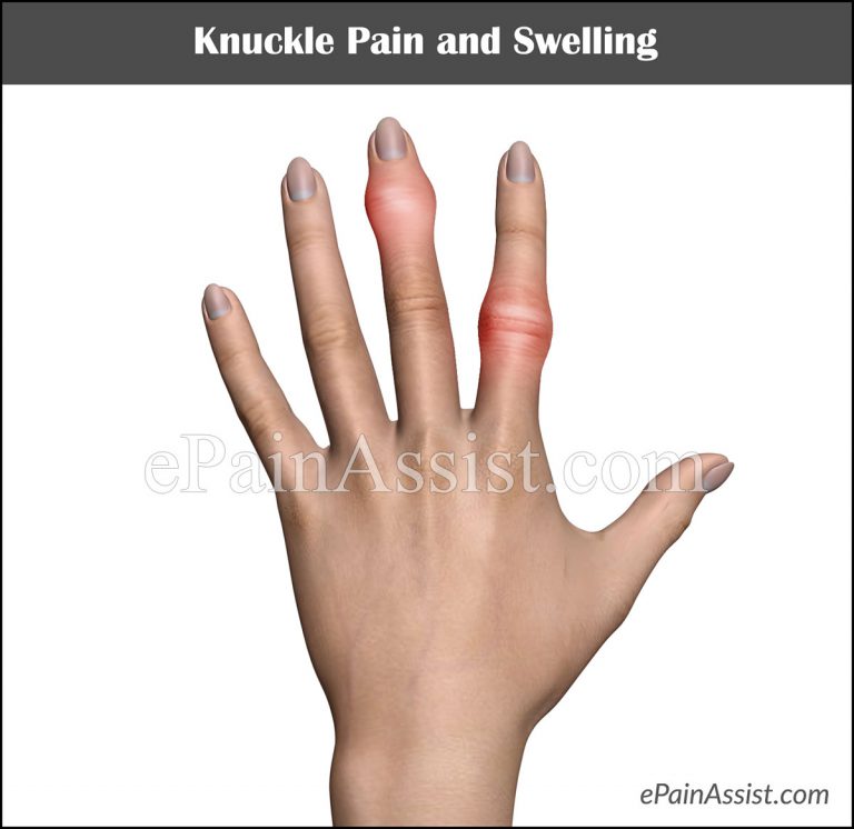 Knuckle Pain & Swelling: Causes, Treatment, Home Remedies