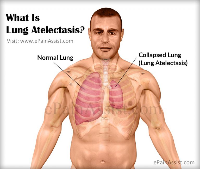 What is Lung Atelectasis & What is its Pathophysiology?