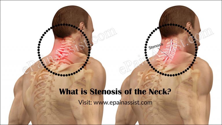 What Causes Stenosis of the Neck & How is it Treated?