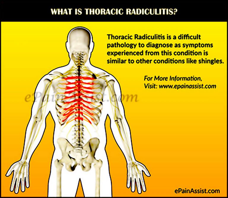 What Can Cause Thoracic Radiculitis and How is it Treated?