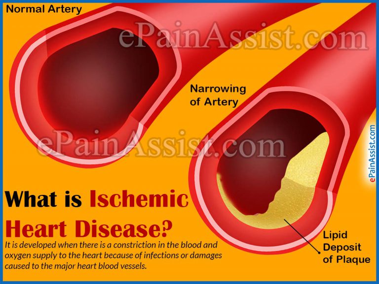 Ischemic Heart Disease: Causes, Signs, Symptoms, Diagnosis