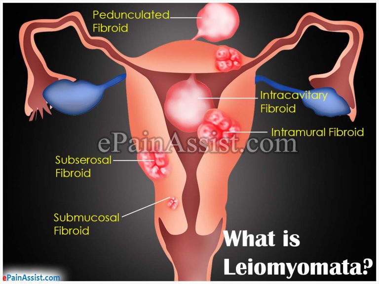 What is Leiomyomata and How is it Treated?
