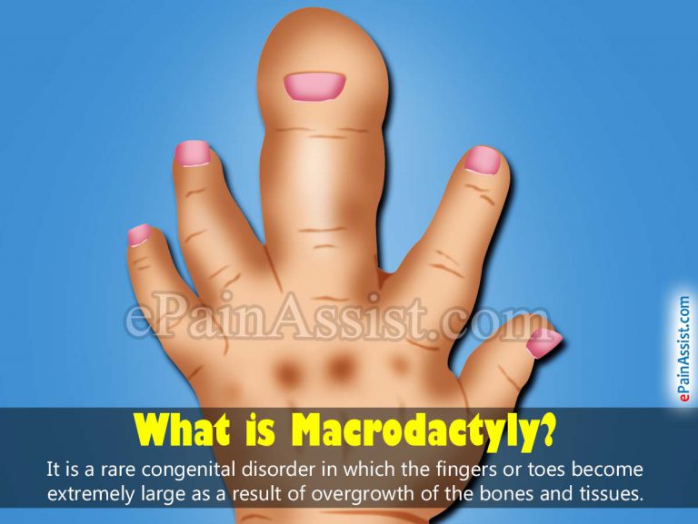 Macrodactyly: Causes, Symptoms, Treatment, Prognosis