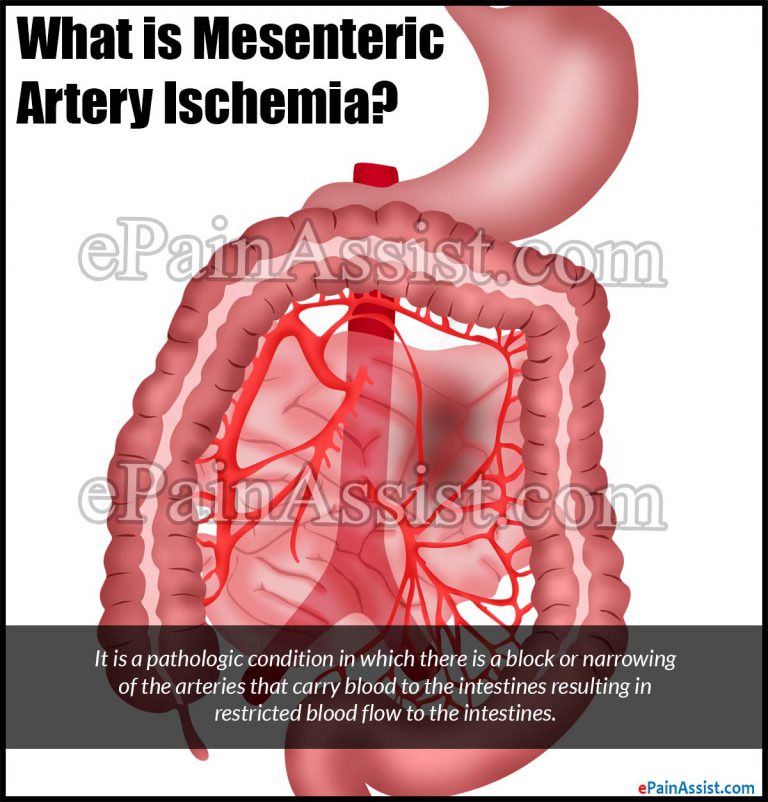 Mesenteric Artery Ischemia: Causes, Symptoms, Treatment