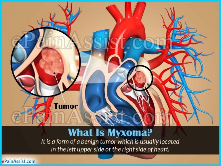 Myxoma: Causes, Symptoms, Diagnosis, Treatment
