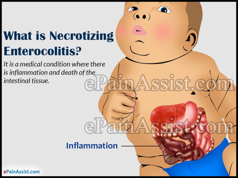 What is Necrotizing Enterocolitis: Treatment, Causes, Symptoms, Surgery