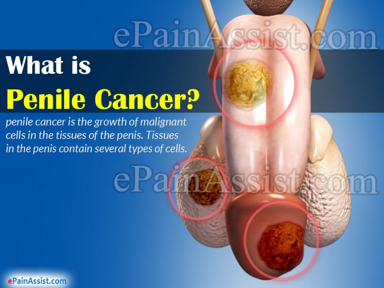Warning Signs of Penile Cancer & Its Diagnosis
