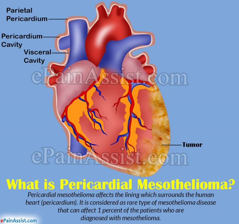 Pericardial Mesothelioma: Causes, Signs, Symptoms, Diagnosis