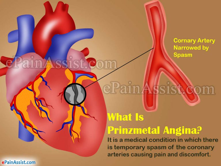 Prinzmetal Angina – Causes, Symptoms, Diagnosis, Treatment