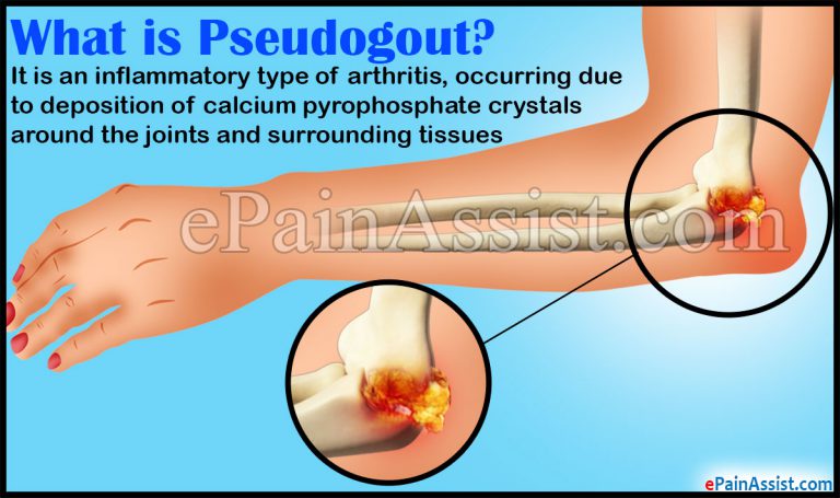 Pseudogout in Elbow: Causes, Symptoms, Treatment, Signs, Diagnosis, FAQs
