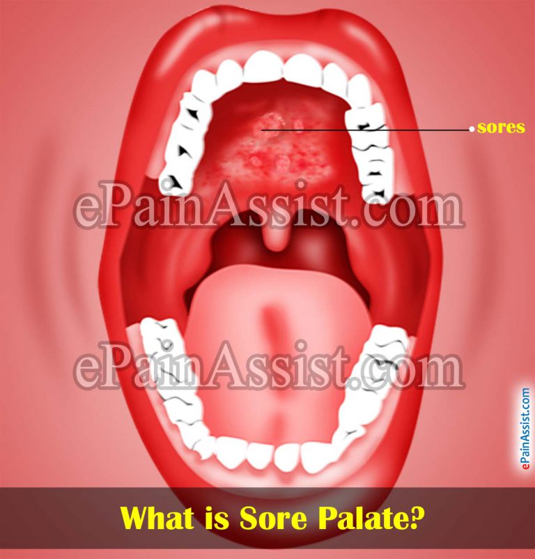 Sore Palate or Sores on Roof of Mouth: Causes & Home Remedies