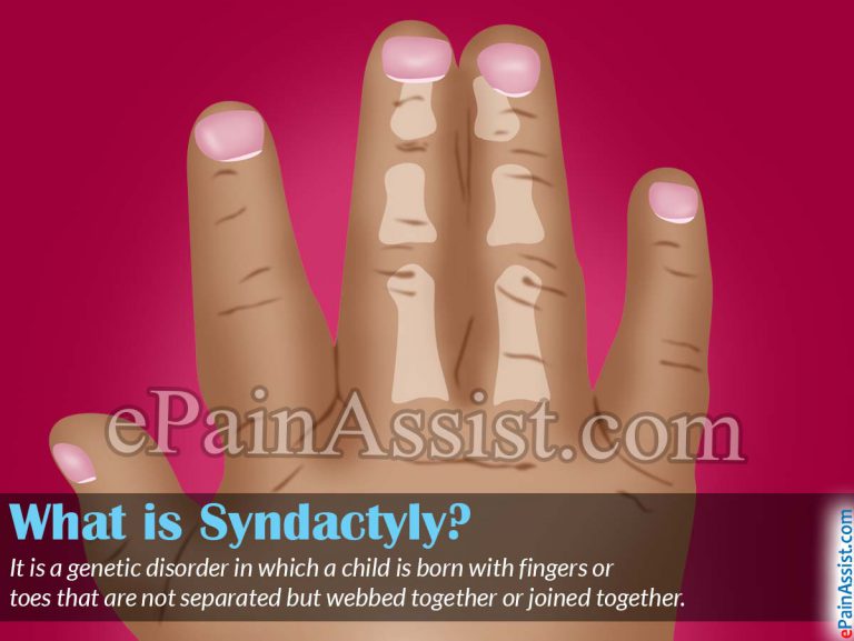 Syndactyly: Causes, Symptoms, Treatment, Prognosis